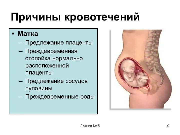 Лекция № 5 Причины кровотечений Матка Предлежание плаценты Преждевременная отслойка