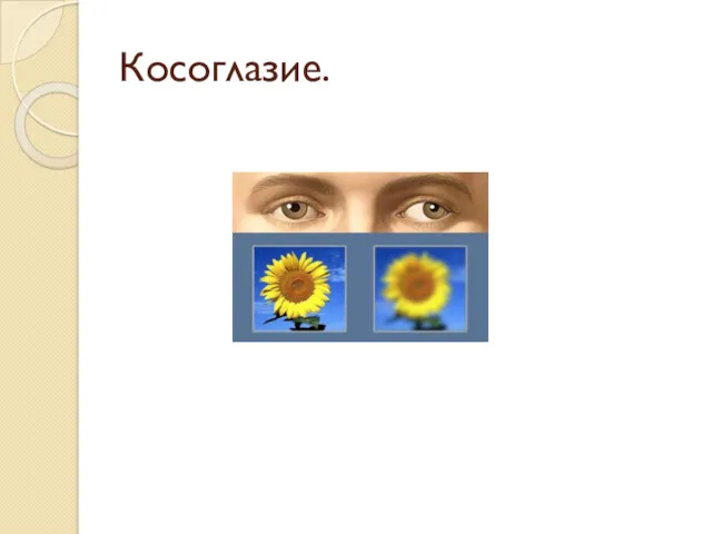 Косоглазие.