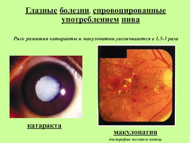 катаракта Глазные болезни, спровоцированные употреблением пива Риск развития катаракты и