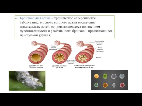 Бронхиальная астма – хроническое аллергическое заболевание, в основе которого лежит воспаление дыхательных путей,