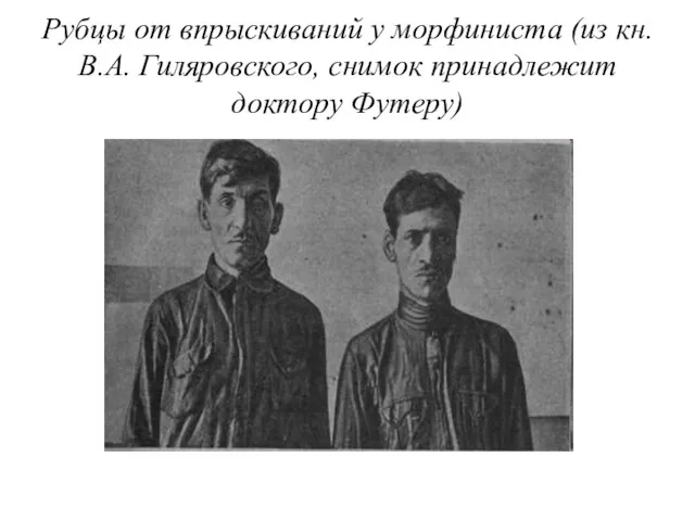 Рубцы от впрыскиваний у морфиниста (из кн. В.А. Гиляровского, снимок принадлежит доктору Футеру)