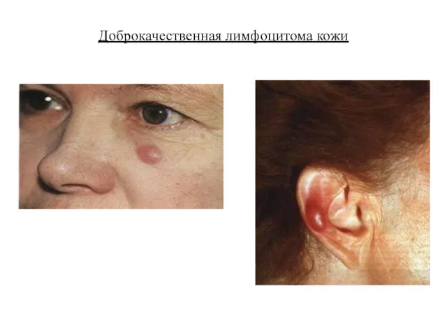 Доброкачественная лимфоцитома кожи