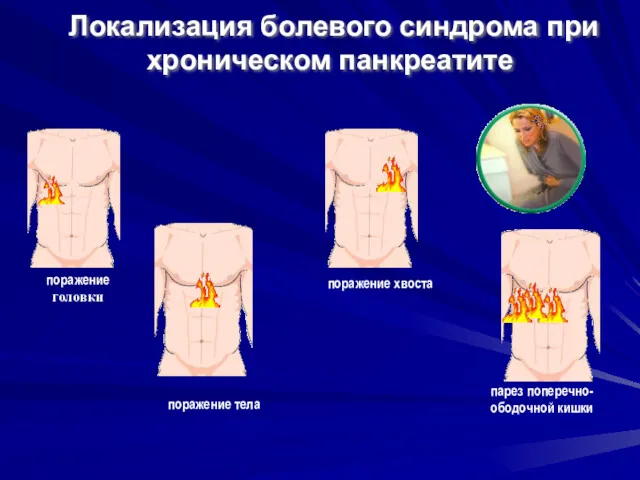 Локализация болевого синдрома при хроническом панкреатите поражение головки поражение тела поражение хвоста парез поперечно- ободочной кишки