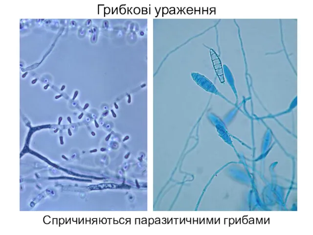 Грибкові ураження Спричиняються паразитичними грибами