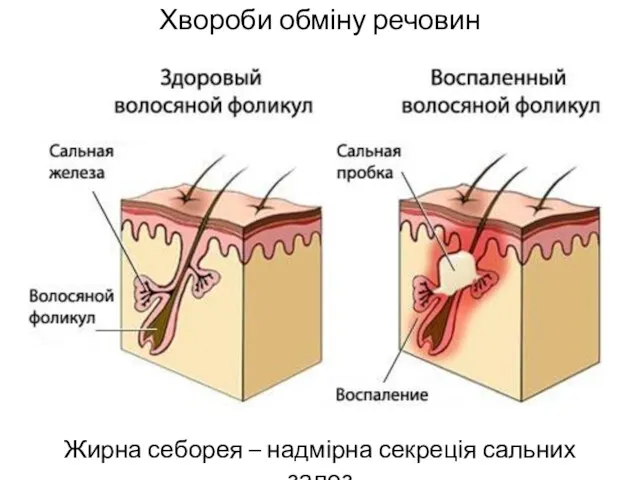 Хвороби обміну речовин Жирна себорея – надмірна секреція сальних залоз