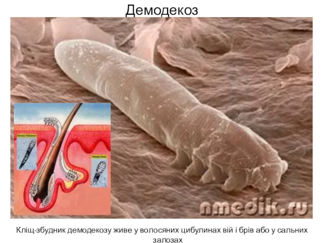 Демодекоз Кліщ-збудник демодекозу живе у волосяних цибулинах вій і брів або у сальних залозах