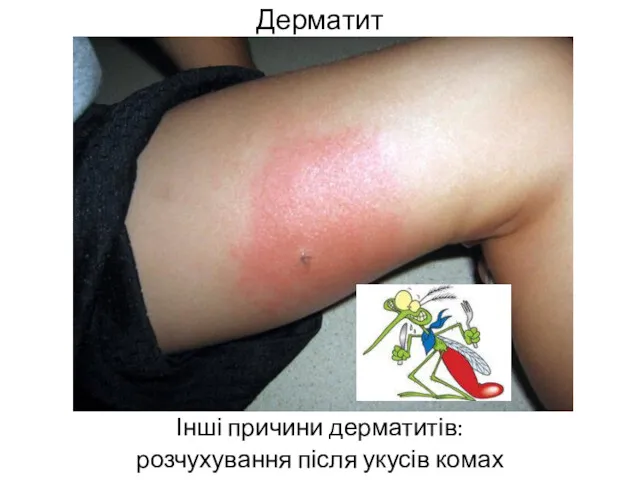 Дерматит Інші причини дерматитів: розчухування після укусів комах