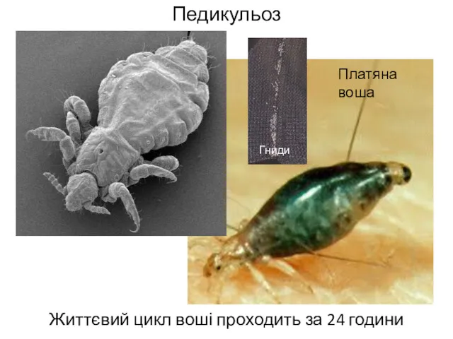 Педикульоз Життєвий цикл воші проходить за 24 години Платяна воша Гниди