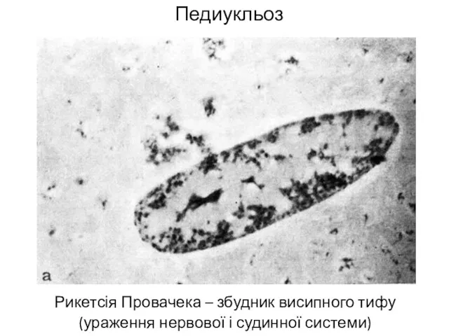 Педиукльоз Рикетсія Провачека – збудник висипного тифу (ураження нервової і судинної системи)