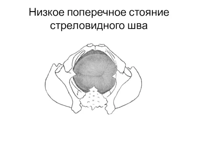 Низкое поперечное стояние стреловидного шва