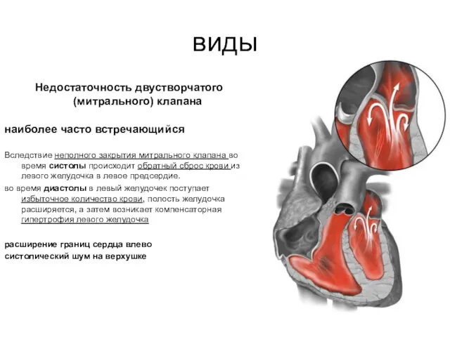 виды Недостаточность двустворчатого (митрального) клапана наиболее часто встречающийся Вследствие неполного