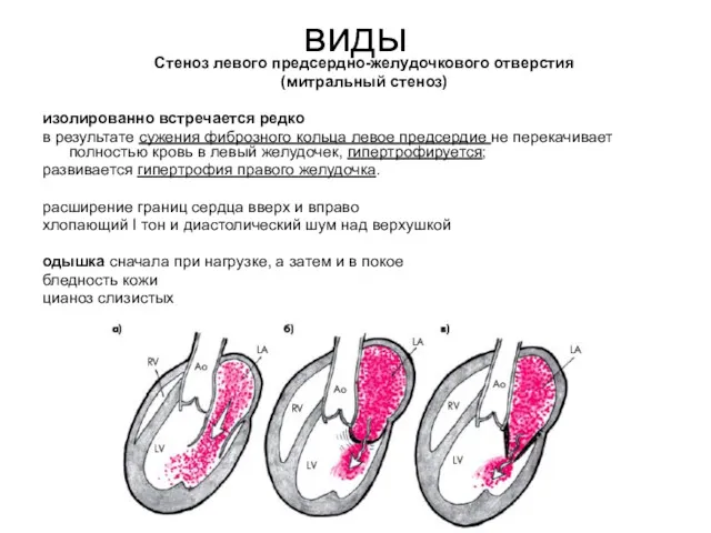 виды Стеноз левого предсердно-желудочкового отверстия (митральный стеноз) изолированно встречается редко