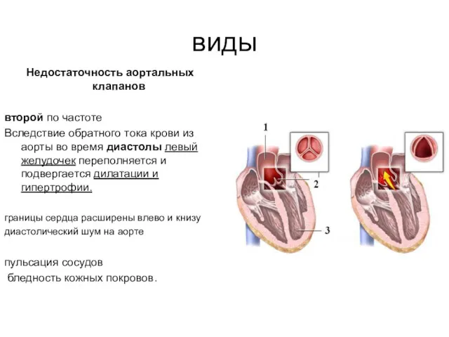 виды Недостаточность аортальных клапанов второй по частоте Вследствие обратного тока