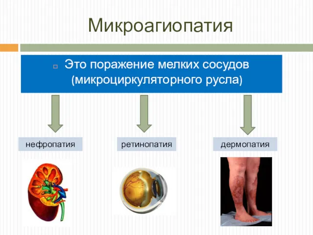 Микроагиопатия Это поражение мелких сосудов (микроциркуляторного русла) нефропатия дермопатия ретинопатия