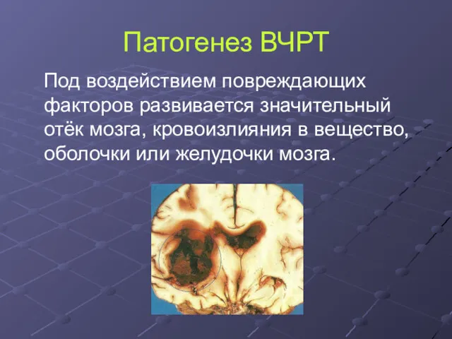 Патогенез ВЧРТ Под воздействием повреждающих факторов развивается значительный отёк мозга,