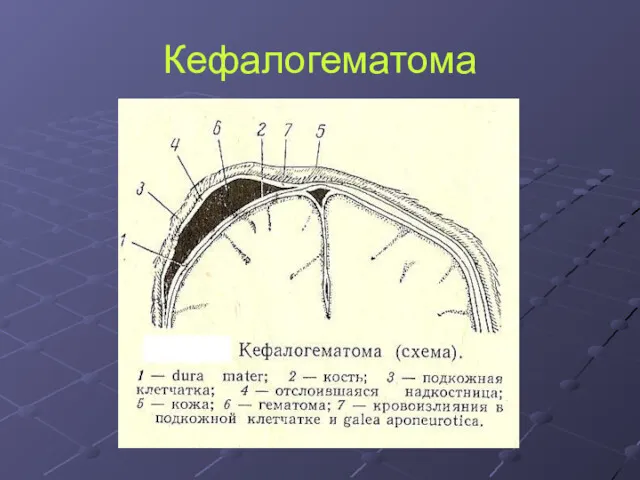 Кефалогематома