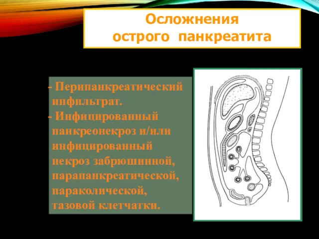 Осложнения острого панкреатита Перипанкреатический инфильтрат. Инфицированный панкреонекроз и/или инфицированный некроз забрюшинной, парапанкреатической, параколической, тазовой клетчатки.