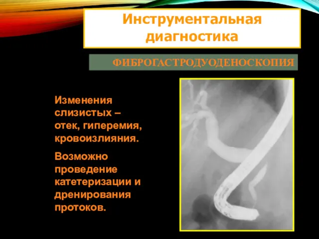 Инструментальная диагностика ФИБРОГАСТРОДУОДЕНОСКОПИЯ Изменения слизистых – отек, гиперемия, кровоизлияния. Возможно проведение катетеризации и дренирования протоков.