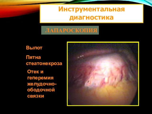 Инструментальная диагностика ЛАПАРОСКОПИЯ Выпот Пятна стеатонекроза Отек и геперемия желудочно-ободочной связки
