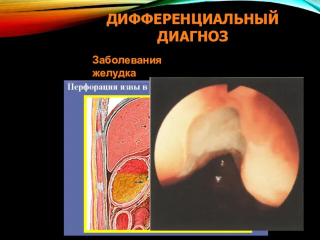 ДИФФЕРЕНЦИАЛЬНЫЙ ДИАГНОЗ Заболевания желудка