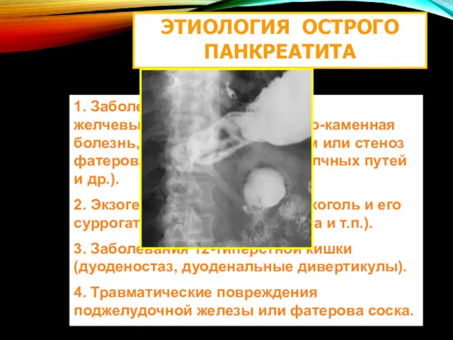 ЭТИОЛОГИЯ ОСТРОГО ПАНКРЕАТИТА 1. Заболевания внепеченочных желчевыводящих путей (желчно-каменная болезнь,