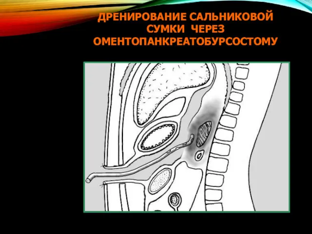 ДРЕНИРОВАНИЕ САЛЬНИКОВОЙ СУМКИ ЧЕРЕЗ ОМЕНТОПАНКРЕАТОБУРСОСТОМУ