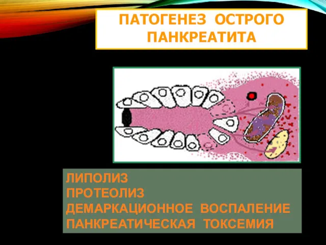 ПАТОГЕНЕЗ ОСТРОГО ПАНКРЕАТИТА ЛИПОЛИЗ ПРОТЕОЛИЗ ДЕМАРКАЦИОННОЕ ВОСПАЛЕНИЕ ПАНКРЕАТИЧЕСКАЯ ТОКСЕМИЯ