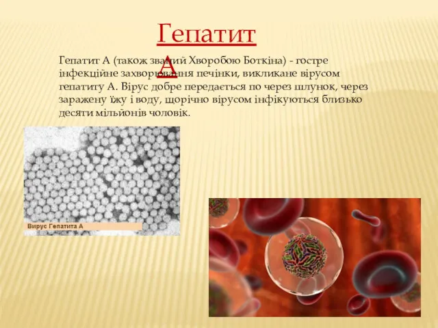 Гепатит A Гепатит A (також званий Хворобою Боткіна) - гостре