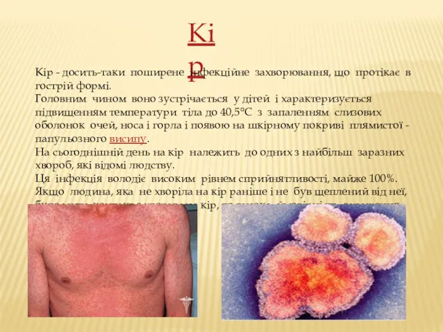 Кір Кір - досить-таки поширене інфекційне захворювання, що протікає в