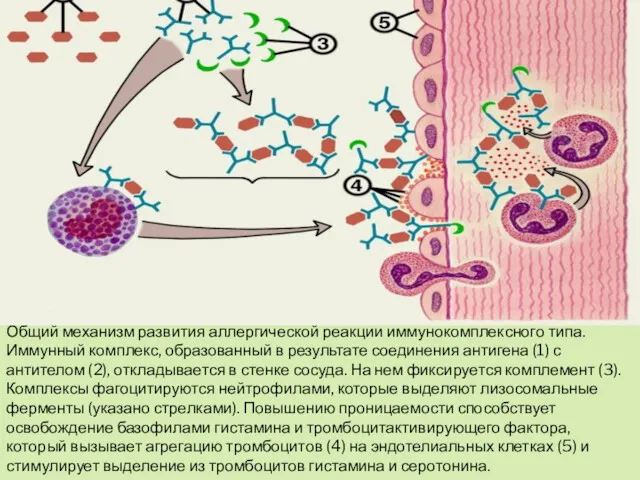 Общий механизм развития аллергической реакции иммунокомплексного типа. Иммунный комплекс, образованный