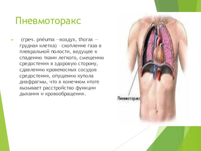 Пневмоторакс (греч. pnéuma —воздух, thorax — грудная клетка) – скопление газа в плевральной