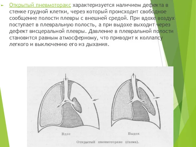 Открытый пневмоторакс характеризуется наличием дефекта в стенке грудной клетки, через который происходит свободное