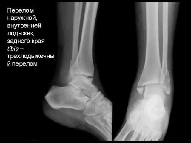 Перелом наружной, внутренней лодыжек, заднего края tibia – трехлодыжечный перелом