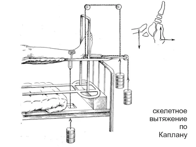 скелетное вытяжение по Каплану