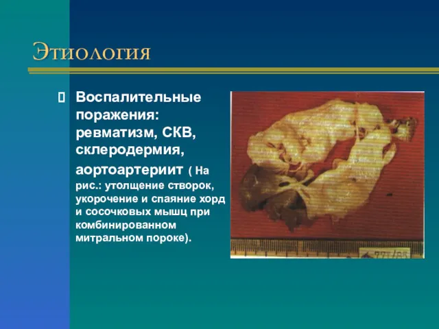 Этиология Воспалительные поражения: ревматизм, СКВ, склеродермия, аортоартериит ( На рис.: