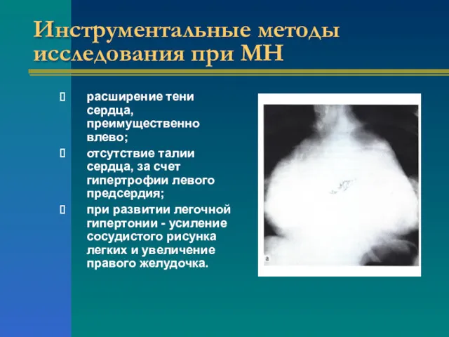 Инструментальные методы исследования при МН расширение тени сердца, преимущественно влево;