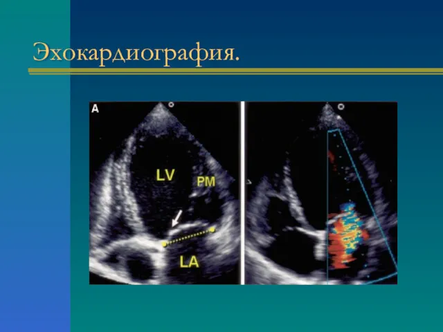 Эхокардиография.