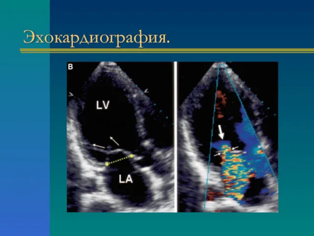 Эхокардиография.