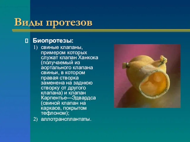 Виды протезов Биопротезы: свиные клапаны, примером которых служат клапан Ханкока