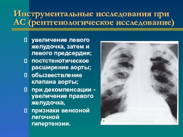 Инструментальные исследования при АС (рентгенологическое исследование) увеличение левого желудочка, затем