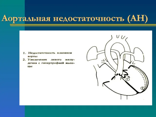 Аортальная недостаточность (АН)