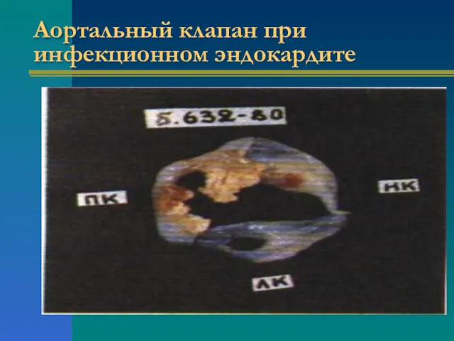 Аортальный клапан при инфекционном эндокардите