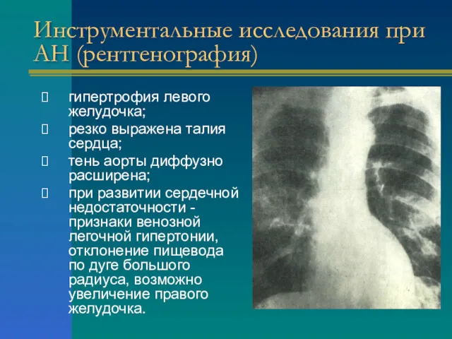 Инструментальные исследования при АН (рентгенография) гипертрофия левого желудочка; резко выражена