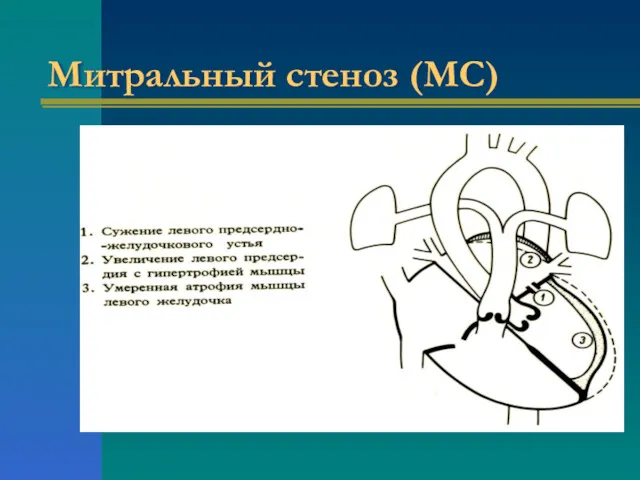 Митральный стеноз (МС)