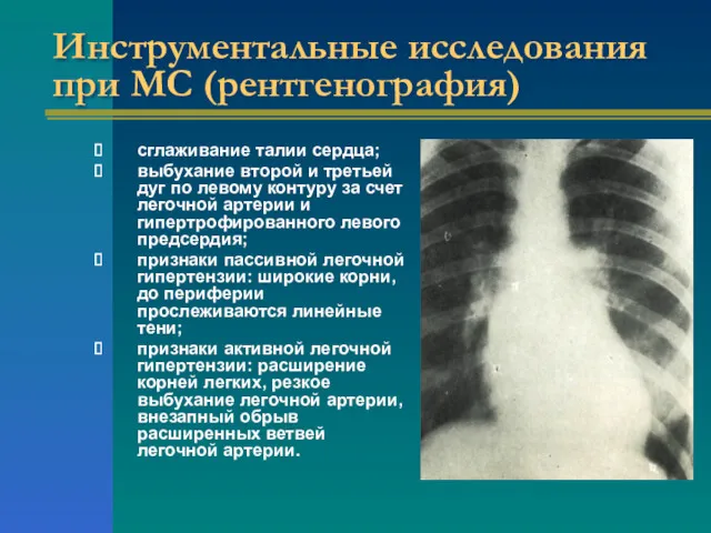 Инструментальные исследования при МС (рентгенография) сглаживание талии сердца; выбухание второй
