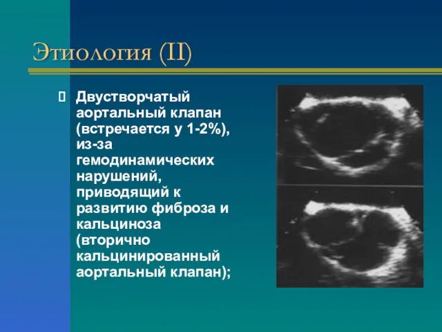 Этиология (II) Двустворчатый аортальный клапан (встречается у 1-2%), из-за гемодинамических