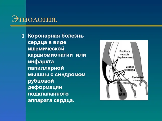 Этиология. Коронарная болезнь сердца в виде ишемической кардиомиопатии или инфаркта