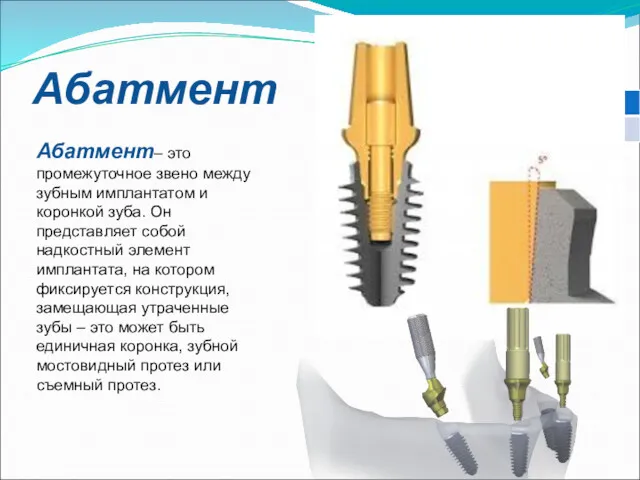 Абатмент Абатмент– это промежуточное звено между зубным имплантатом и коронкой