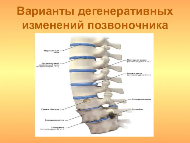 Варианты дегенеративных изменений позвоночника