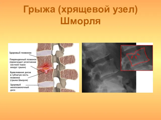 Грыжа (хрящевой узел) Шморля